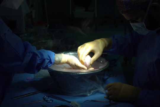 A 25 anni riceve un rene dalla madre: il primo trapianto in anestesia loco-regionale all'IRCCS Sant’Orsola