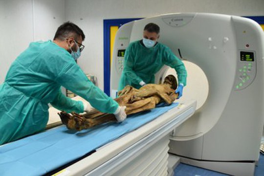 Nel corpo mummificato del Venerabile Giacomo Torno emerge il più antico caso di ulcera terminale di Kennedy